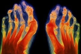 rheumatoid arthritis-270x180