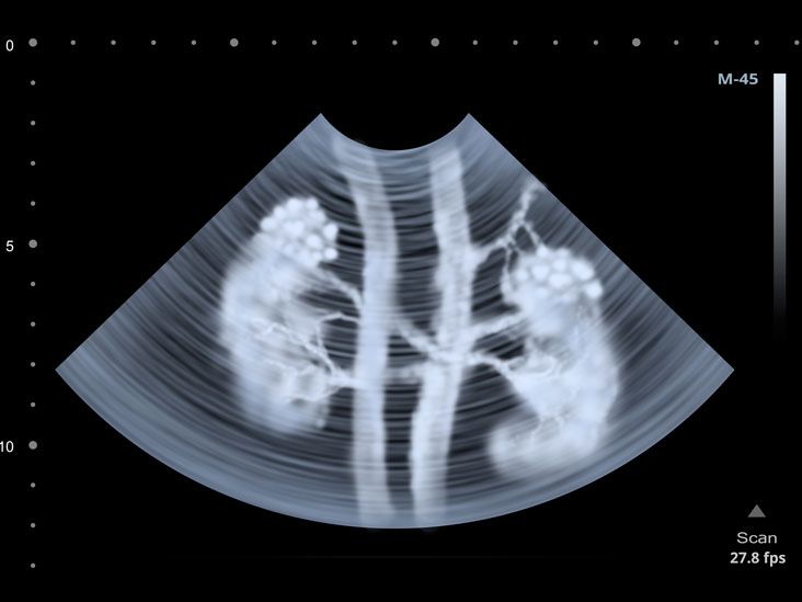 renal scan