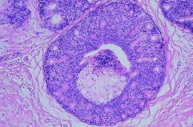 Breast Intraductal Carcinoma