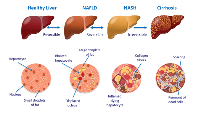 NAFLD Progression